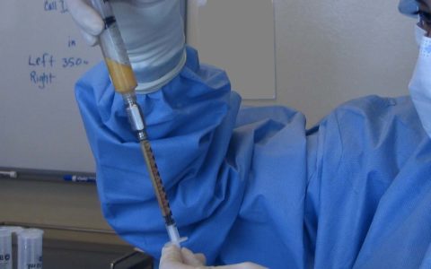 De nouvelles recommandations pour l’injection de graisse dans la poitrine