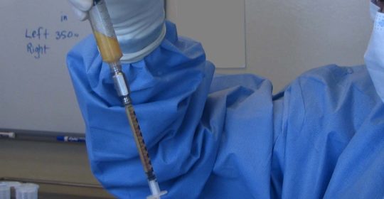 De nouvelles recommandations pour l’injection de graisse dans la poitrine