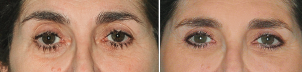 Une bonne crème sous les yeux des oedèmes