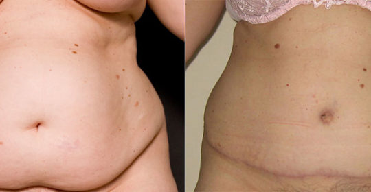 Plastie Abdominale