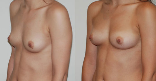Lipofilling sein 1