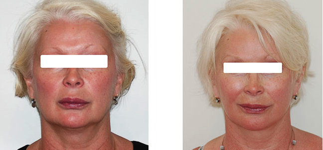 Lifting du visage et du cou - cervico-facial - à Paris Lifting du visage et du cou - cervico-facial - à Paris