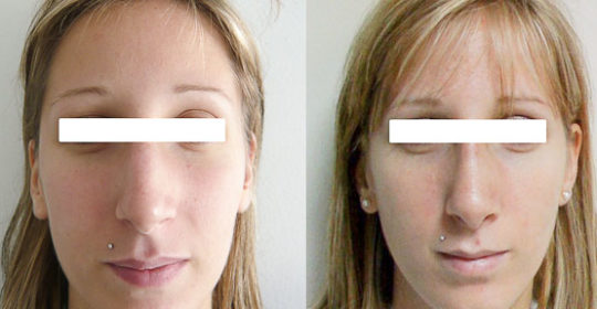 Résultat rhinoplastie 2 voie ouverte vue de Face