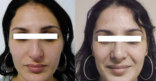 Résultat rhinoplastie 1 voie fermée vue de Face