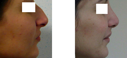 Résultat rhinoplastie 1 voie fermée vue de Profil