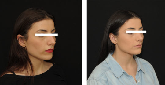 Résultat rhinoplastie 7 ultrasonique vue de 3/4