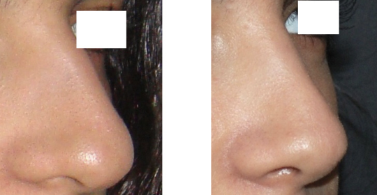 Résultat rhinoplastie 5 voie fermée vue de 3/4