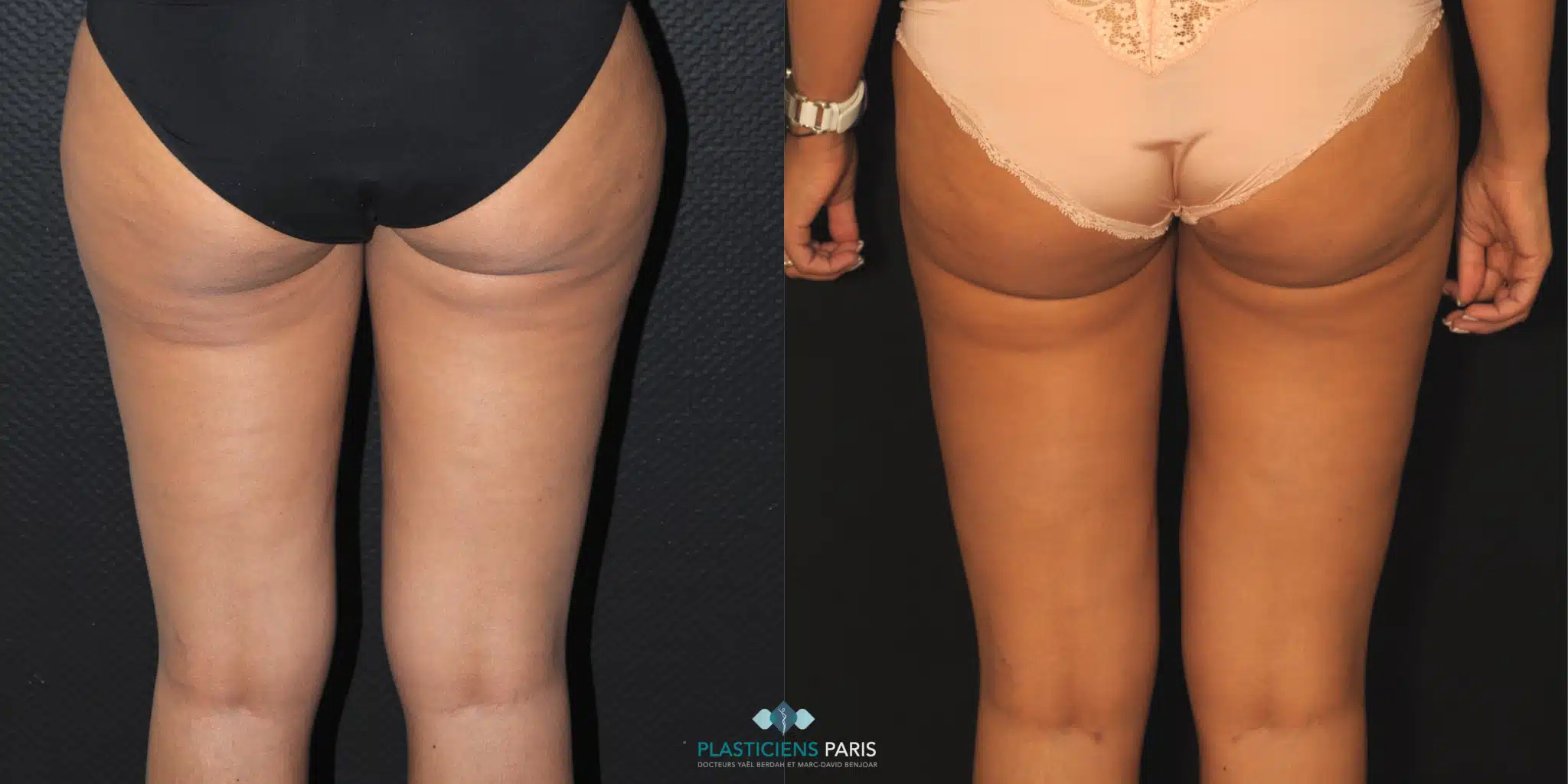 liposuccion des cuisses avant et après