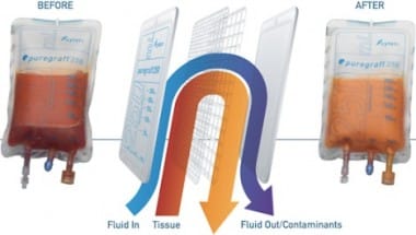 Transfert de graisse