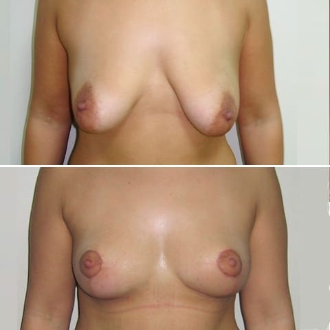 avant apres ptose mammaire face