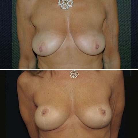 avant apres ptose mammaire face