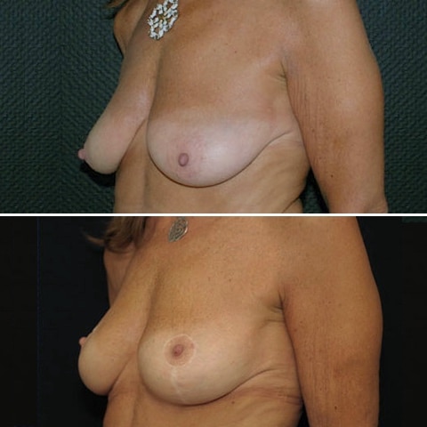 avant apres ptose mammaire