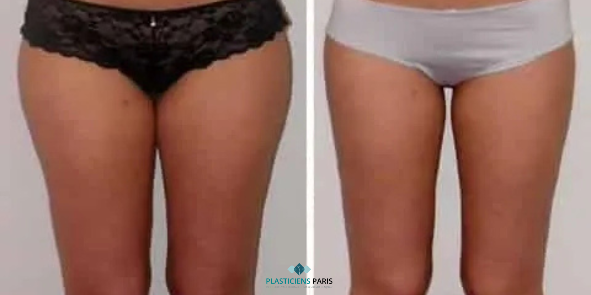 liposuccion cuisses avant après