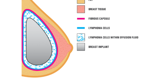 Prothèse mammaire – Lymphome et prothèses mammaires