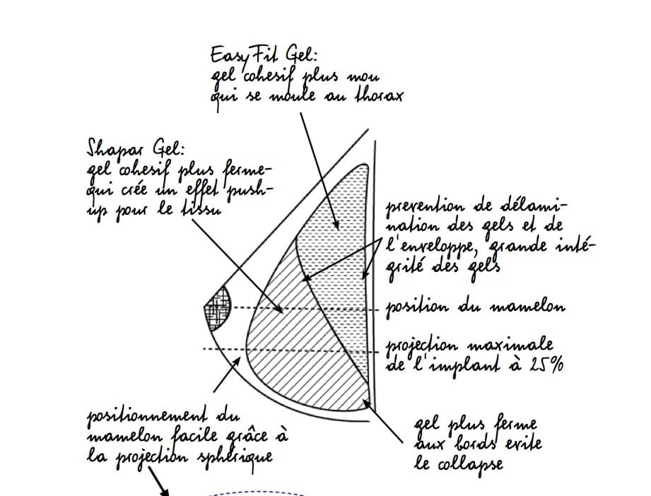 Implant-mammaire-nouvelle-génération