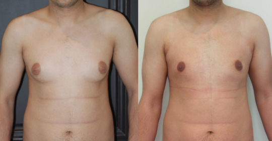 Adipomastie par liposuccion exclusive