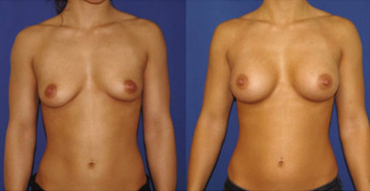 implant mammaire anatomique 320 cc haute projection résultat FACE