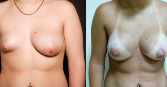 Lipofilling sein 3