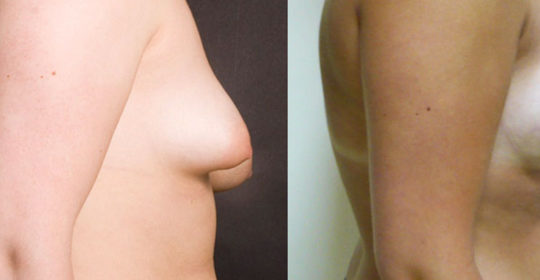 Lipoffiling des seins – Photos avant et après, vue de profil