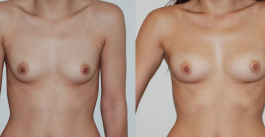 Lipofilling des seins, augmentation mammaire sans implant. Vue de face