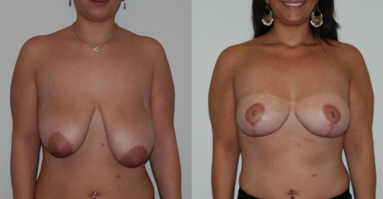 Cure de ptose et réduction mammaire, vue de face