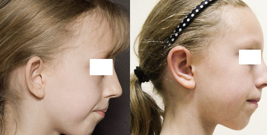 Avant / Après opération oreilles décollées. Photo de profil.