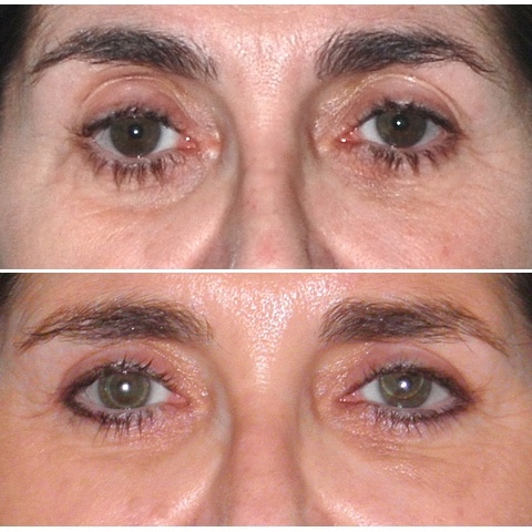 Blépharoplastie Ou Chirurgie Des Paupieres Le Lifting Des Yeux à Paris