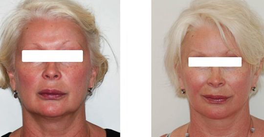 Lifting cervico-facial avant / après. Vue de face