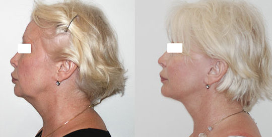 Lifting cervico-facial double plan. Vue de profil