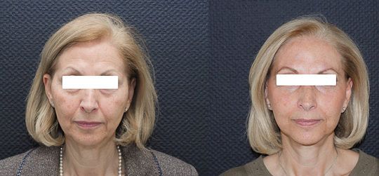 Lifting cervico-facial double plan. Vue de face.