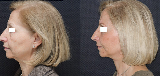 Lifting cervico-facial double plan. Vue de profil.