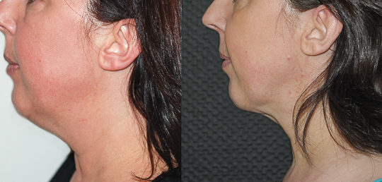 Liposuccion du cou, vue de profil