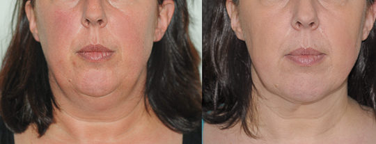 Liposuccion du cou, vue de face.