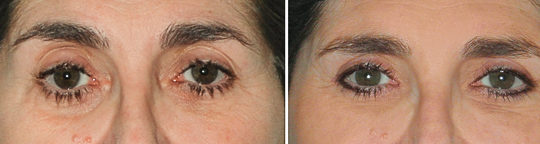 Chirurgie des quatre paupières avec lipofilling du creux sus palpébral.