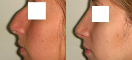 Rhinoplastie 2 voie ouverte : vue de profil