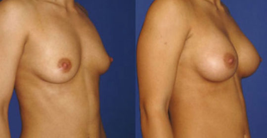 implant mammaire anatomique 320 cc haute projection résultat PROFIL