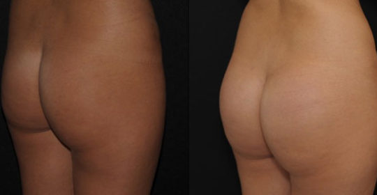 Implants fessiers 360 cc résultats vue 3/4