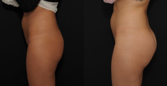 Implants fessiers 360 cc résultats vue Profil