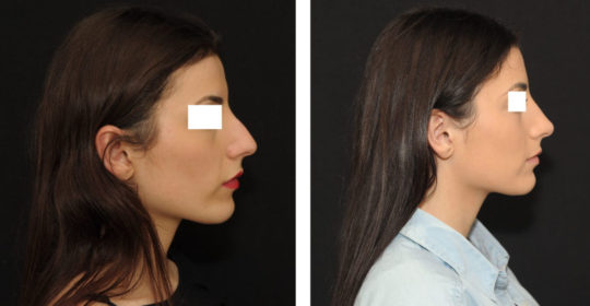 Rhinoplastie 7 ultrasonique vue de profil