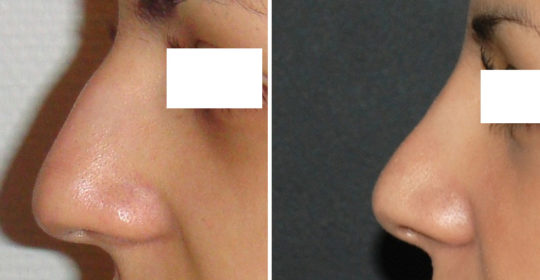 Rhinoplastie 5 voie fermée vue de profil