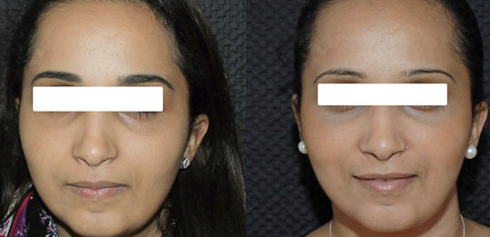 Rhinoplastie 6 voie fermée vue de face