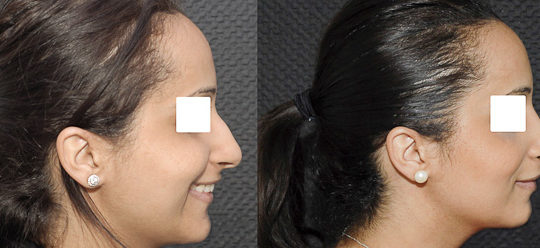 Rhinoplastie 6 voie fermée vue de profil