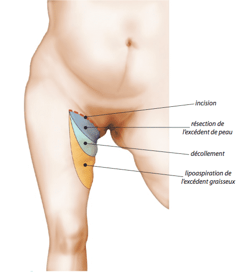 Le lifting de cuisse ou cruroplastie - Plasticiens Paris