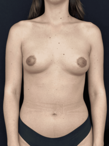 Seins tubereux Apres vue de face