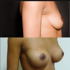protesi mammaria rotonda 350 cc ad alta proiezione risultato PROFILO35 anni, donna. Seno 90 B con volume ridotto dopo l'allattamento. Areola grande che consente una cicatrice sul bordo inferiore. I tessuti del torace sono molto sottili e non possono nascondere una protesi situata davanti al muscolo. L'aumento del seno viene eseguito attraverso l'areola. Una protesi riempita con gel di silicone ad alto profilo rotondo MOTIVA da 350 cc viene inserita dietro il muscolo dopo un doppio distacco davanti e dietro il muscolo (tecnica Dual-Plane). Risultato a 6 mesi con un C/D di 95 che conferisce un aspetto naturale.