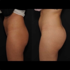 Implantes de glúteos 360 cc resultados vista de perfil