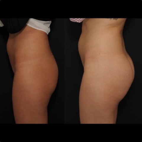 Implants fessiers 360 cc résultats vue de profil