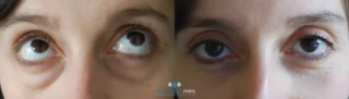 cirugía de las bolsas del párpado inferior, foto antes/después. Resultado de la cirugía de la bolsa del párpado inferior con una cicatriz en la conjuntiva (desde el interior del párpado).