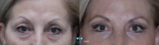 resultados antes y después de una blefaroplastia de 4 párpados en una mujer.