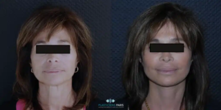 lifting facial plano profundo trabajo sobre el óvalo los cordones platismales y el cuello y ángulo de la mandíbula combinado con lipofilling facial restauración de volúmenes y luminosidad de la piel